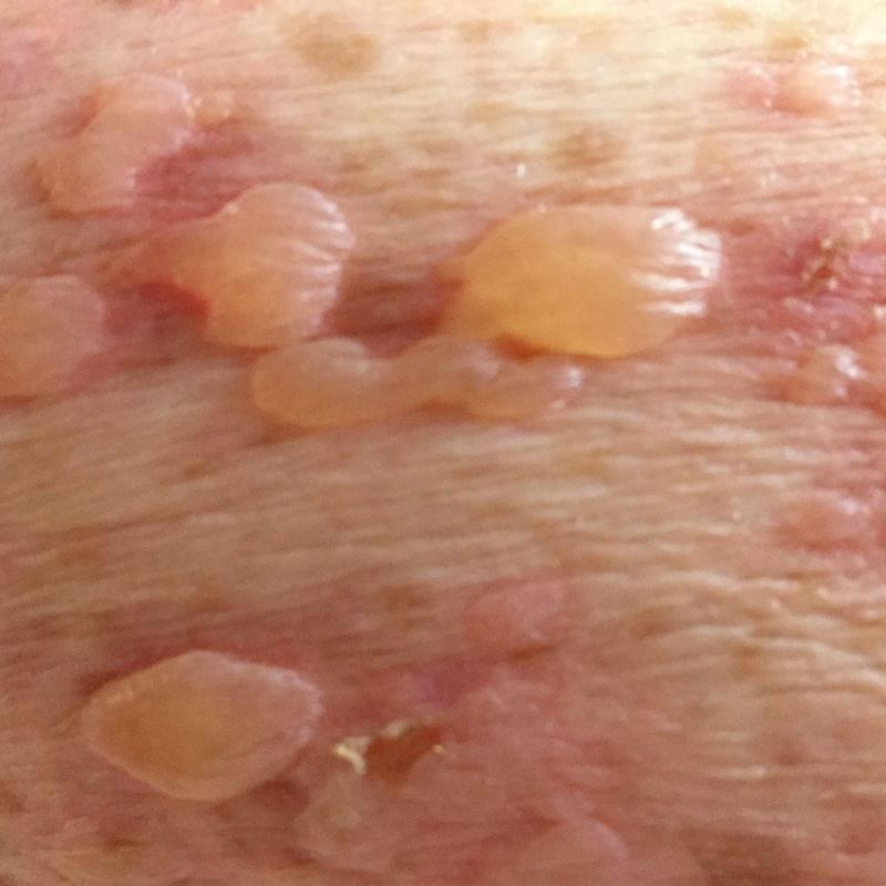 blaasjeseczeem/dyshidrotisch eczeem