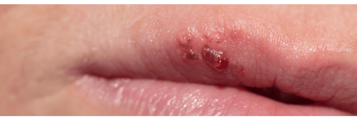 Koortslip | Snel van je koortslip af | Boots Apotheek