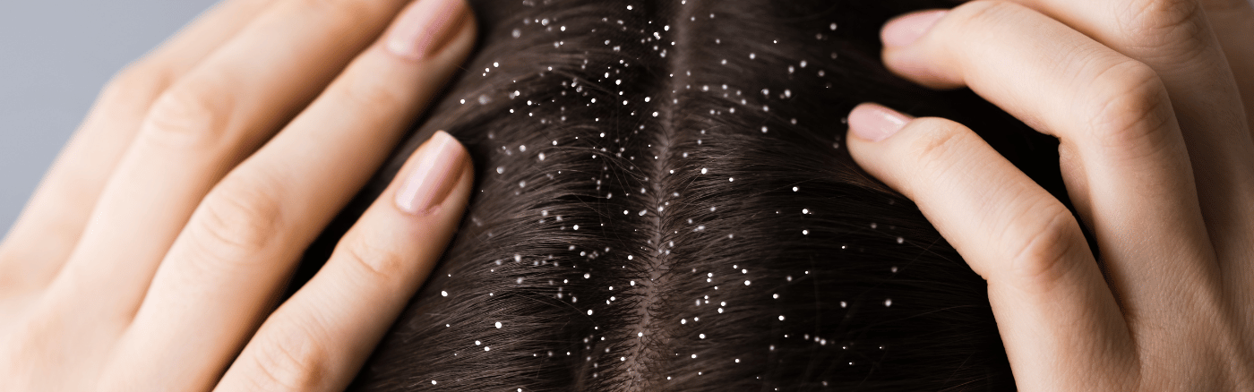 anti roos shampoo kopen anti roos shampoo kopen