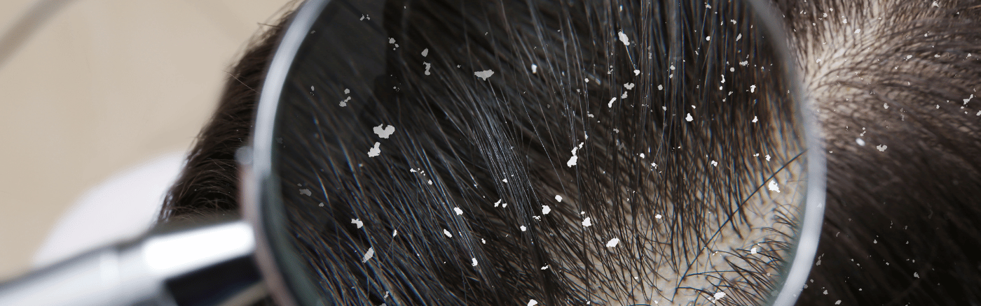 anti roos shampoo kopen anti roos shampoo kopen