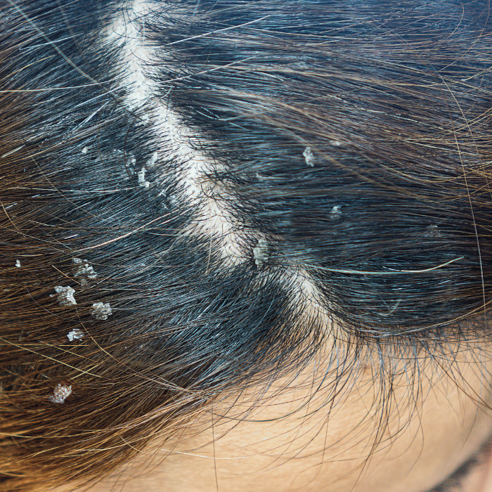 anti roos shampoo kopen anti roos shampoo kopen