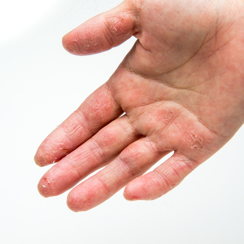 blaasjeseczeem/dyshidrotisch eczeem op de hand